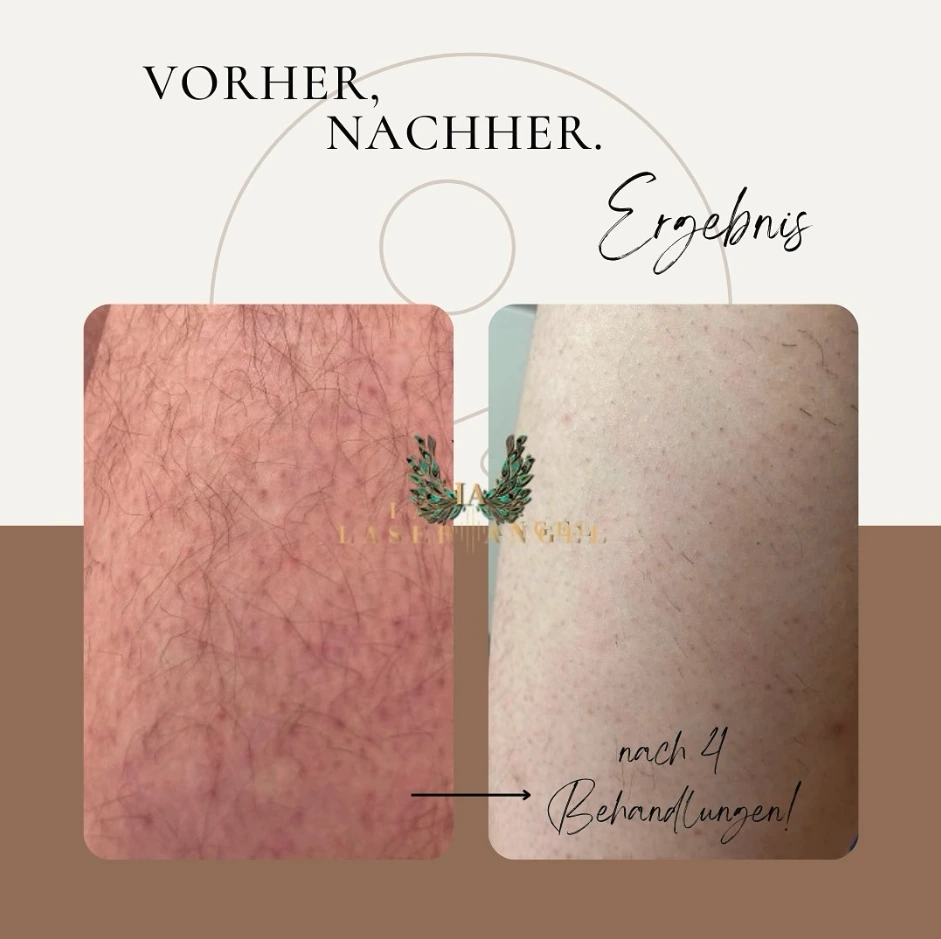 Vorher-Nachher Ergebnisse der Laser-Haarentfernung bei Laser Angel Hamburg